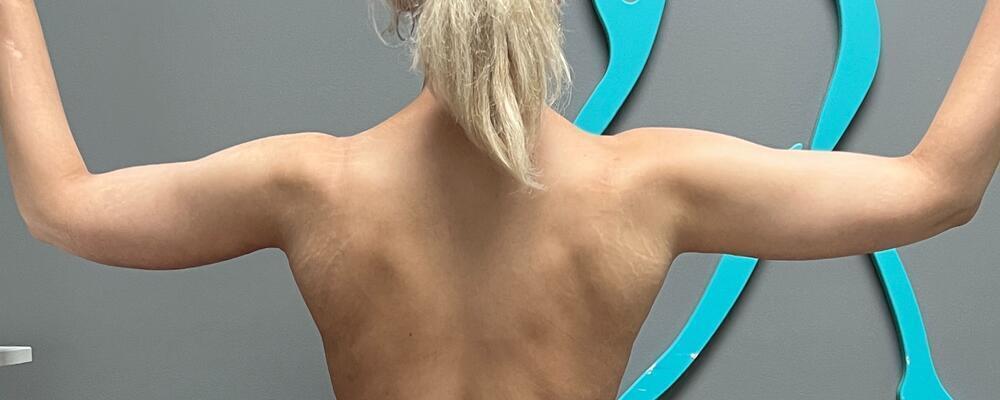 Arm Lift Before & After Image